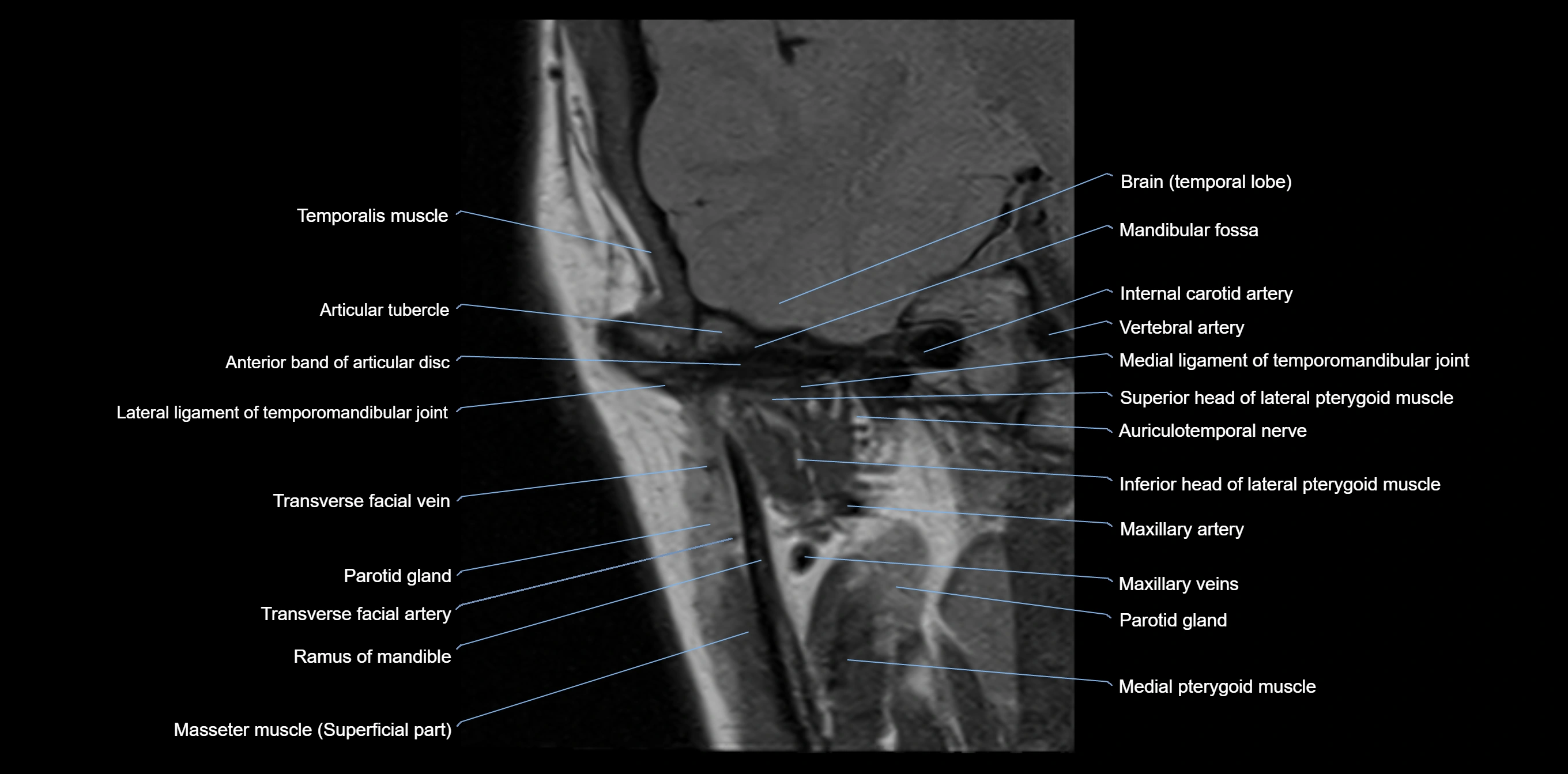 MRI TMJ coronal cross sectional 3T anatomy -img-00004-00004.webp